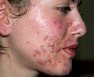 acne-vinagre